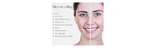 microneedling